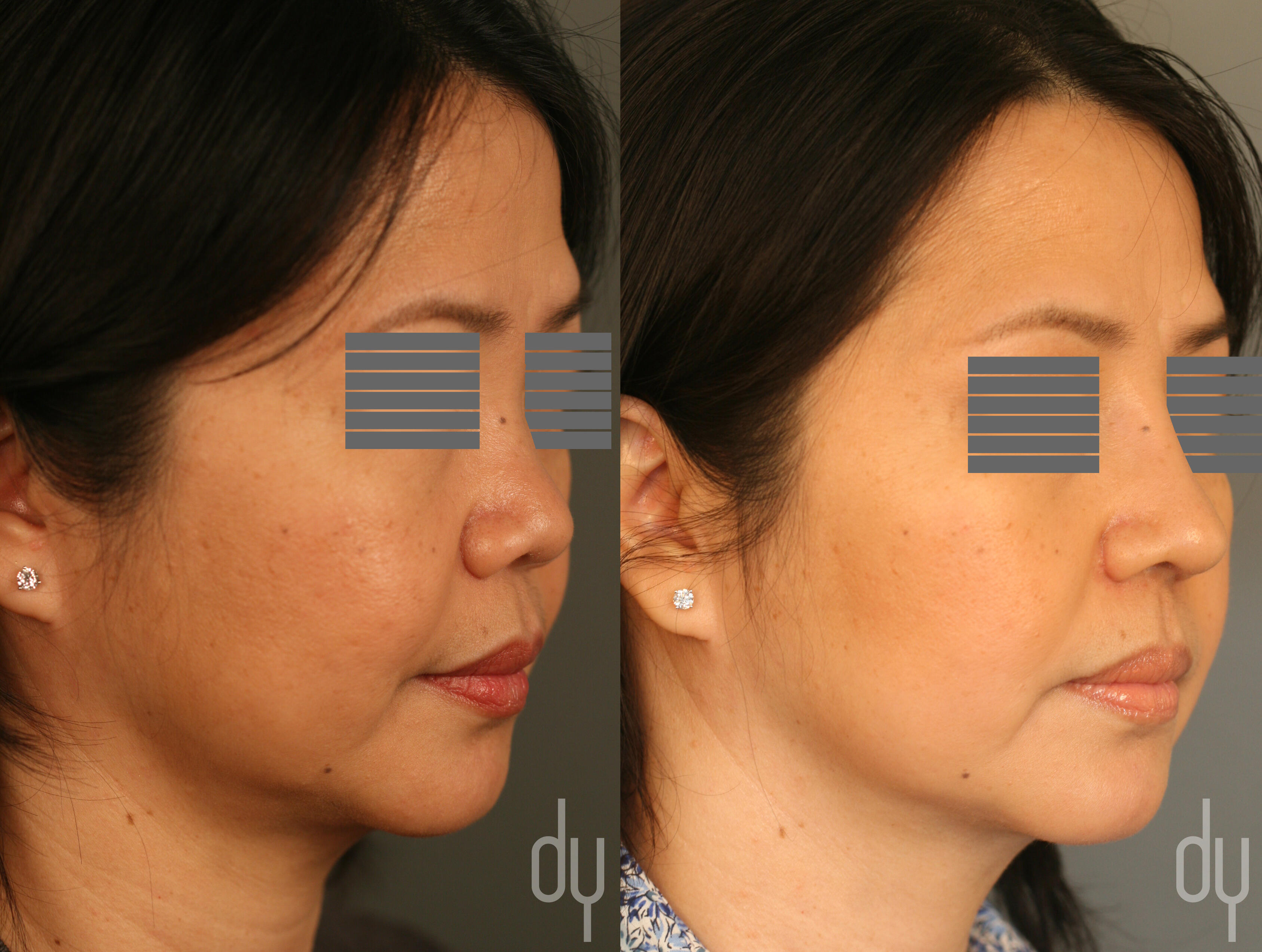 Asian rhinoplasty, Asian plastic surgery, diced cartilage