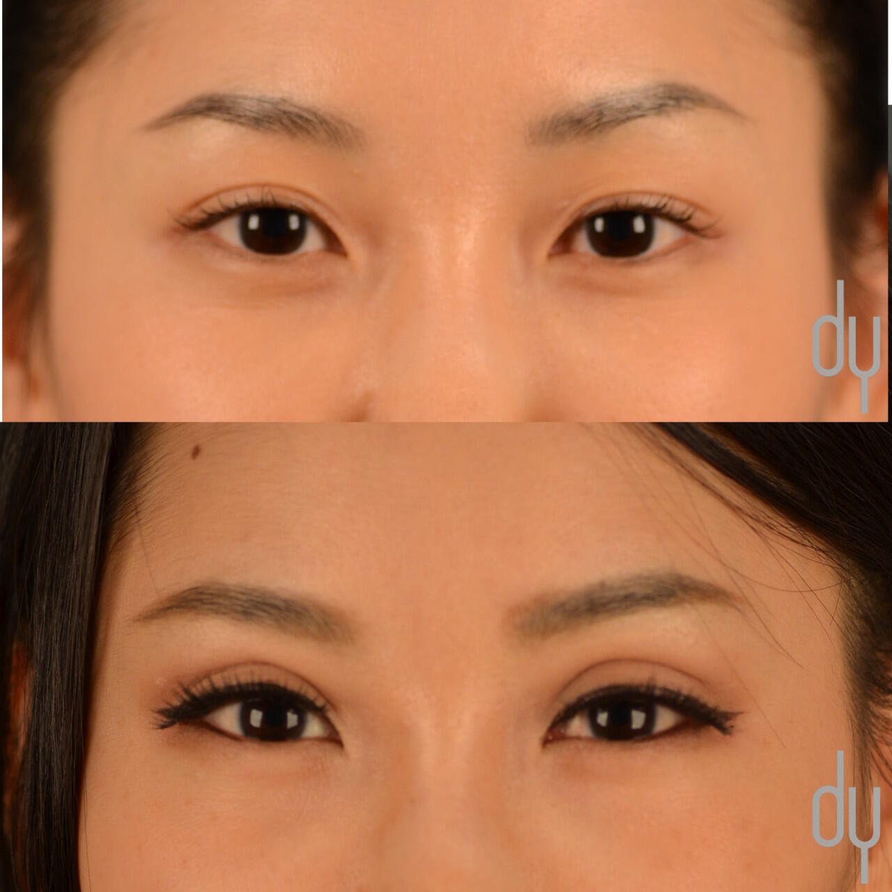 Asian Eyelid Surgery Before And After 32