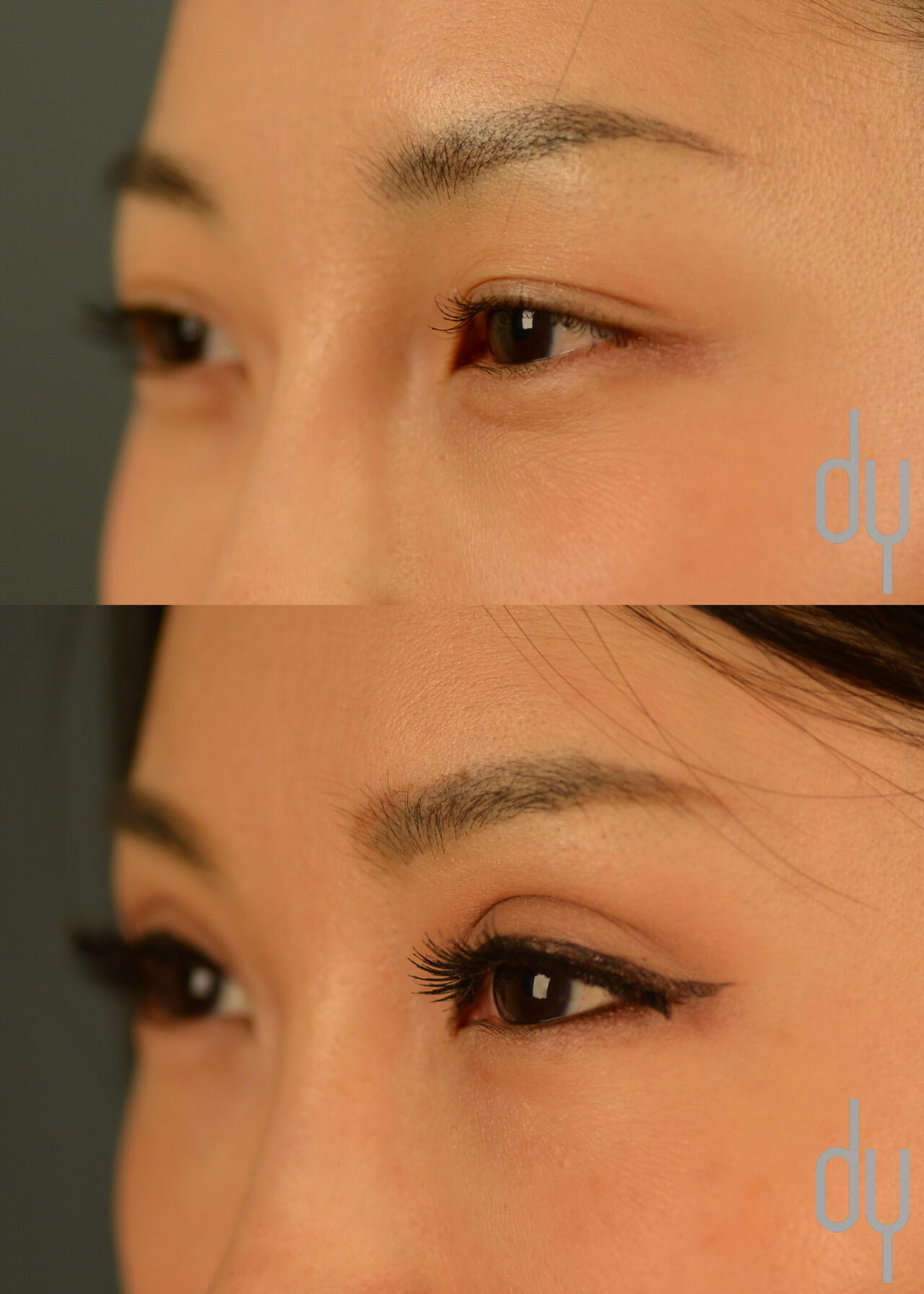 blepharoplasty before and after asian