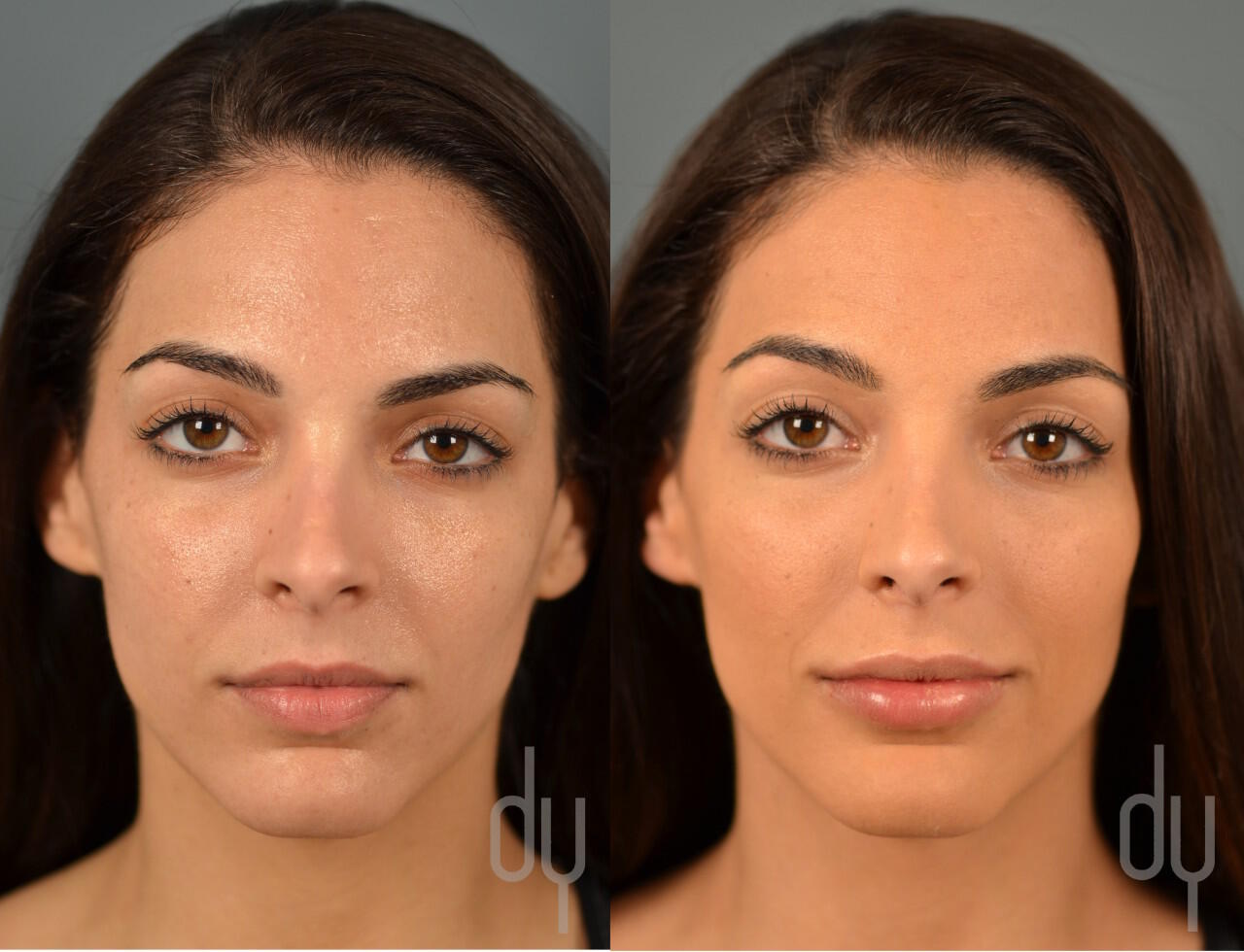 Before And After Lip Augmentation Using Restylane® Restylane Silk