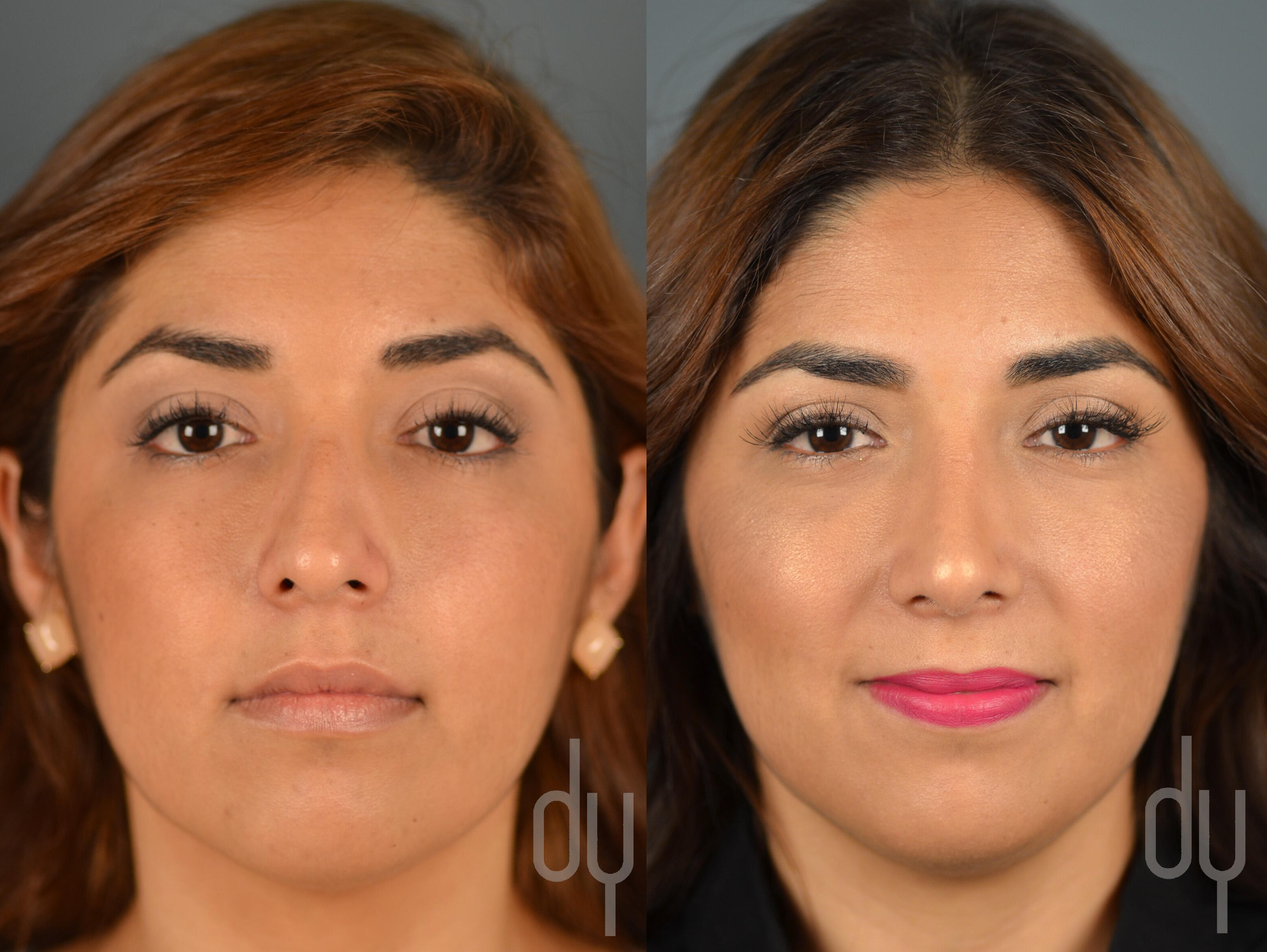 Cosmetic surgery and medicine procedures nose job or rhinoplasty