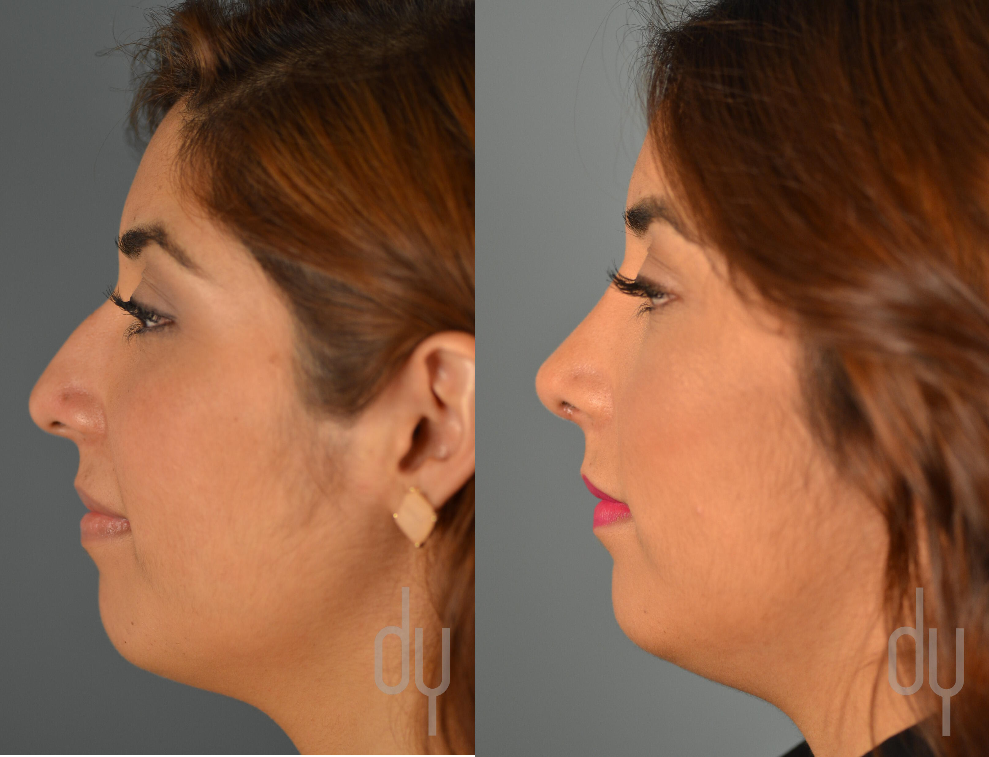 Rhinoplasty Nose Job Recovery with Rhinoplasty Specialist Dr. Donald