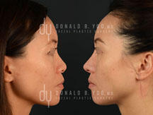 Primary Asian rhinoplasty (before and after)