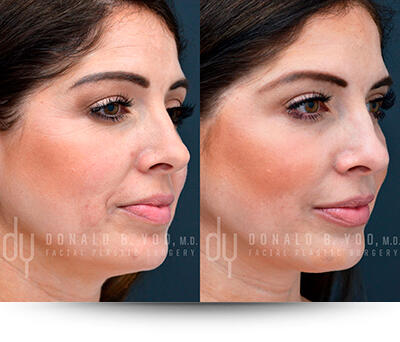 Before and after of Botox/Dysport procedure
