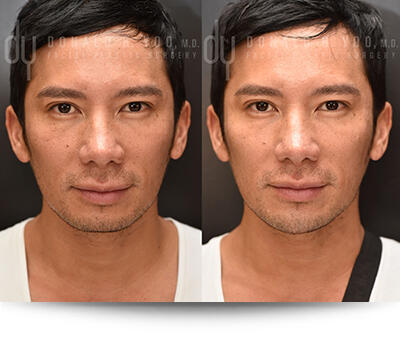 Before and After Photo of Chin and Jawline Filler