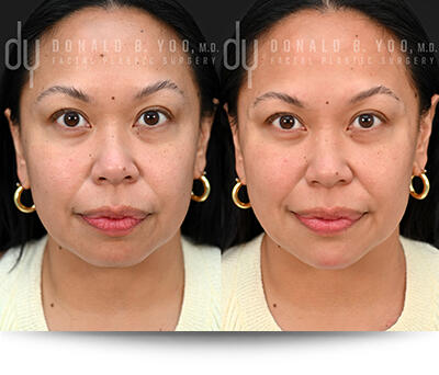Before and After Photo of Chin and Jawline Augmentation Procedure
