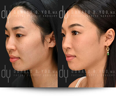 Before and After Nonsurgical Chin Augmentation
