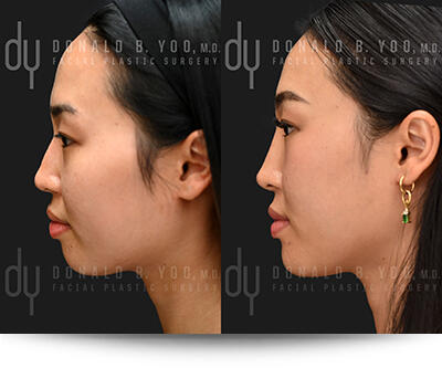 Before and After Chin and Jawline Augmentation Left Profile