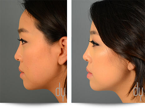1st Before and After Photo of Non Surgical Rhinoplasty Results