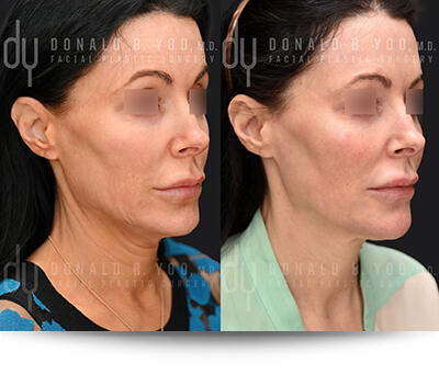 Before and After Photo of Potenza Results