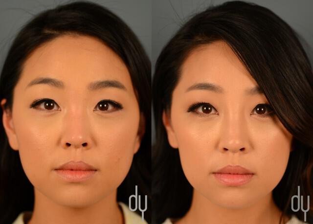 Before and After Non Surgical Rhinoplasty (Frontal view) | Beverly