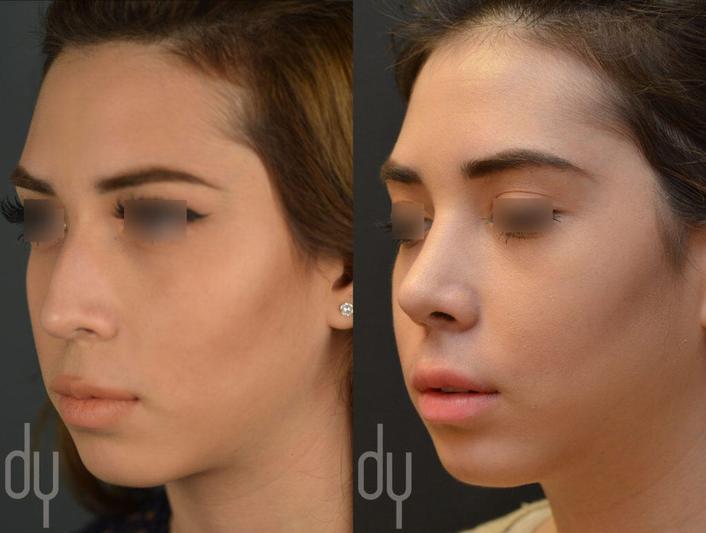 Primary Rhinoplasty Before and After Beverly Hills Facial Plastic
