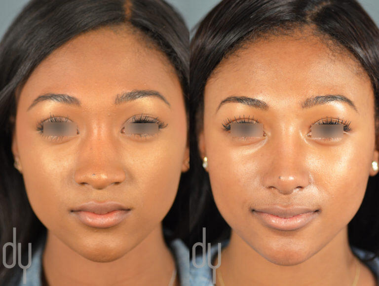 Primary RhinoplastyBefore and After Beverly Hills Facial Plastic Surgery Donald B. Yoo M.D.