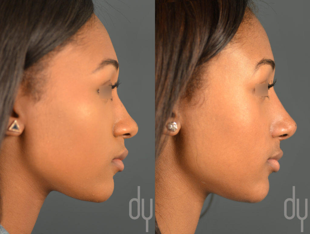Primary RhinoplastyBefore and After Beverly Hills Facial Plastic Surgery Donald B. Yoo M.D.