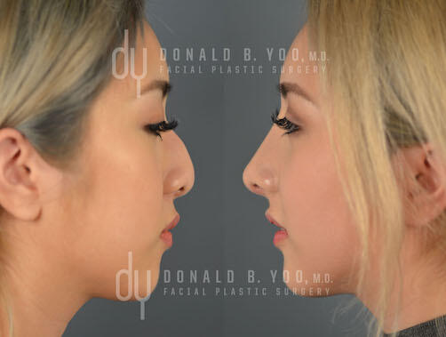 SURGICAL :: RHINOPLASTY<br>Asian Rhinoplasty with Rib Cartilage and DCF