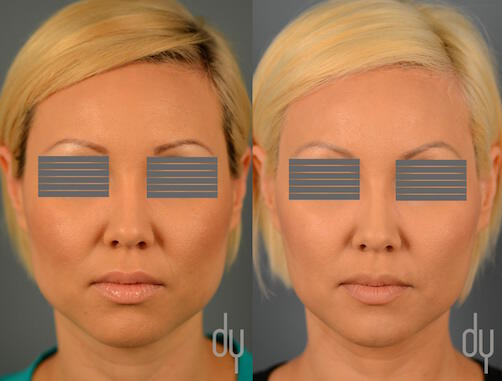 NONSURGICAL :: BOTOX<br>V-line Masseter Reduction