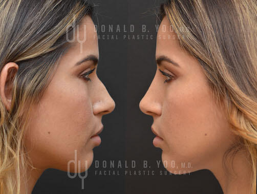 NONSURGICAL :: FILLERS<br>Nonsurgical Rhinoplasty