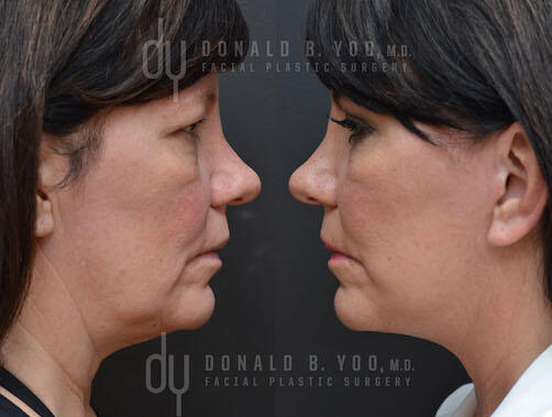 SURGICAL :: FACELIFT<br>Deep Plane Facelift