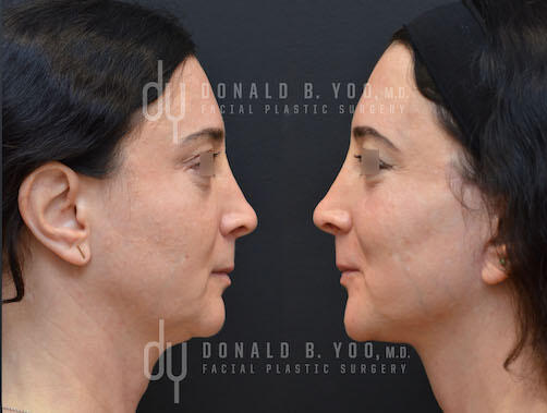 SURGICAL :: FACELIFT<br>Deep Plane Facelift