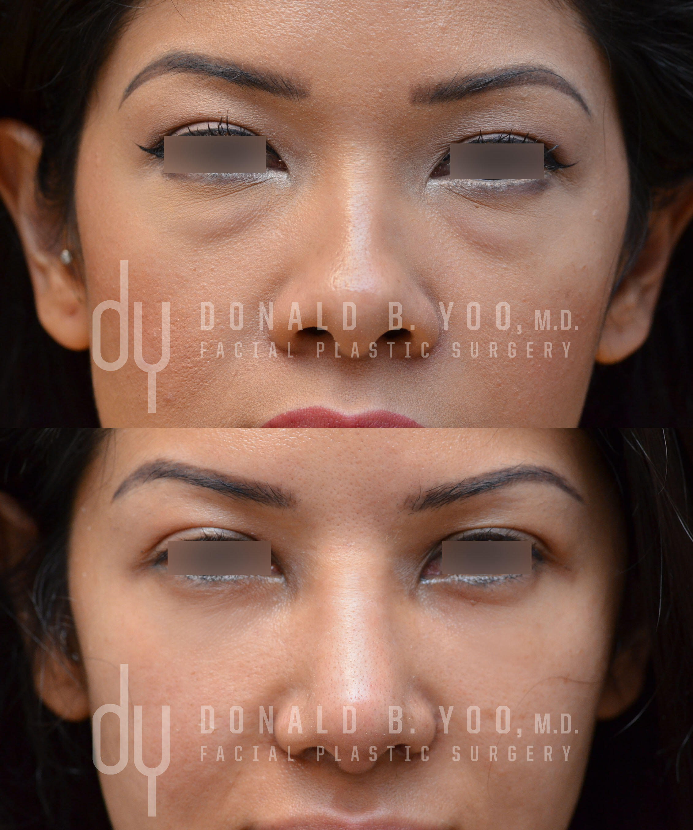 SURGICAL :: BLEPHAROPLASTY<br>Lower Blepharoplasty with Fat Repositioning