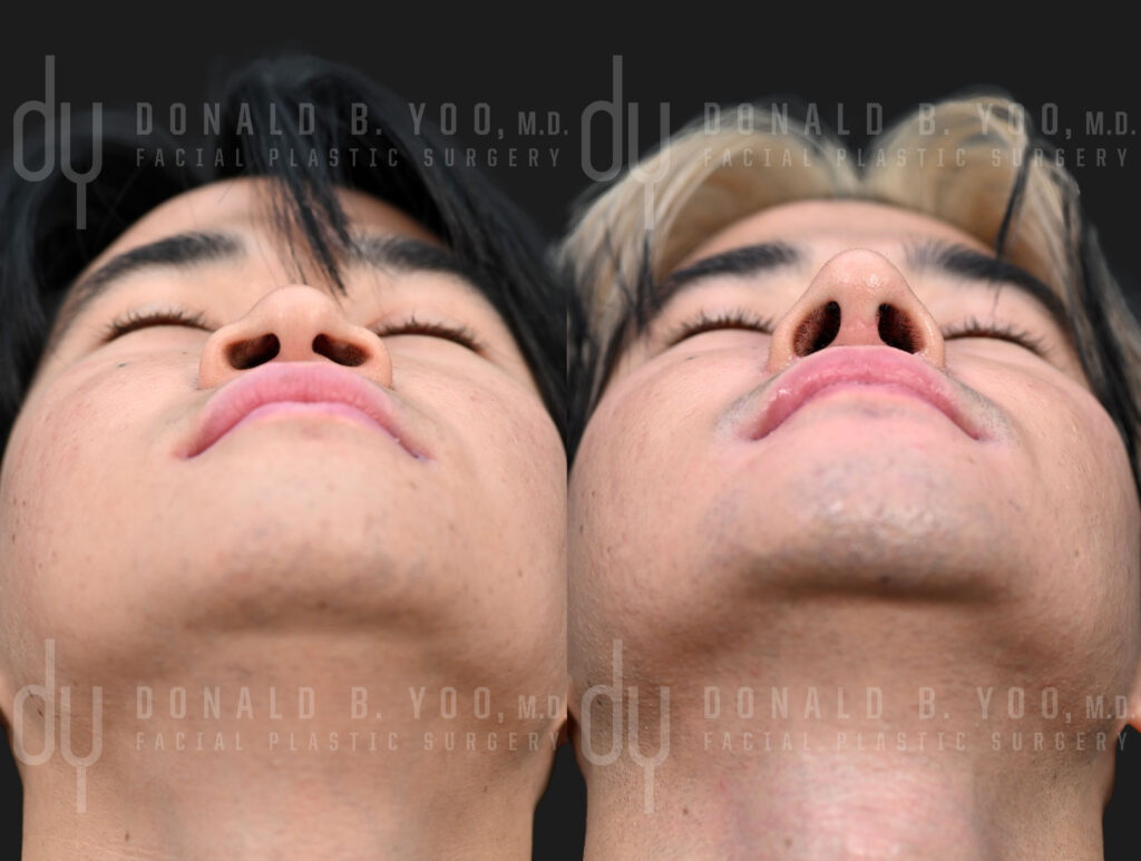 Male Asian rhinoplasty with rib cartilage, DCF, and alarplasty before and after — Beverly Hills facial plastic surgeon Dr. Donald Yoo