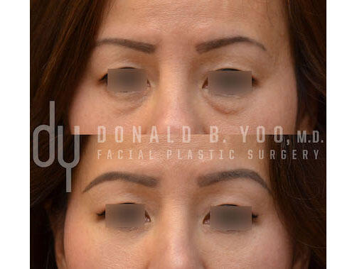 SURGICAL :: BLEPHAROPLASTY<br>Lower Blepharoplasty with Fat Repositioning