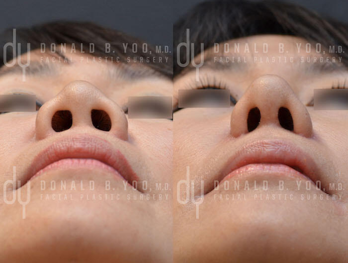 SURGICAL :: RHINOPLASTY<br>Alar Base Modification