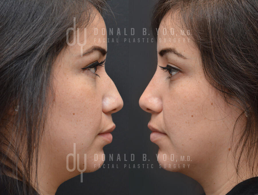 NONSURGICAL :: FILLERS<br>Nonsurgical Rhinoplasty