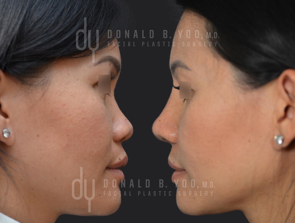 SURGICAL :: RHINOPLASTY<br>Asian Rhinoplasty with Rib Cartilage and DCF