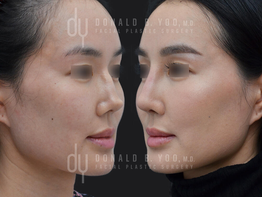 SURGICAL :: RHINOPLASTY<br>Revision Asian Rhinoplasty with Rib Cartilage and DCF