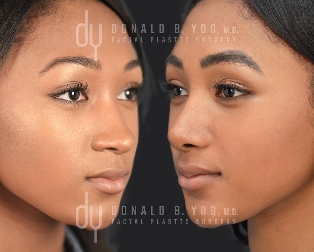 SURGICAL :: RHINOPLASTY<br>African American Rhinoplasty with Rib Cartilage and DCF