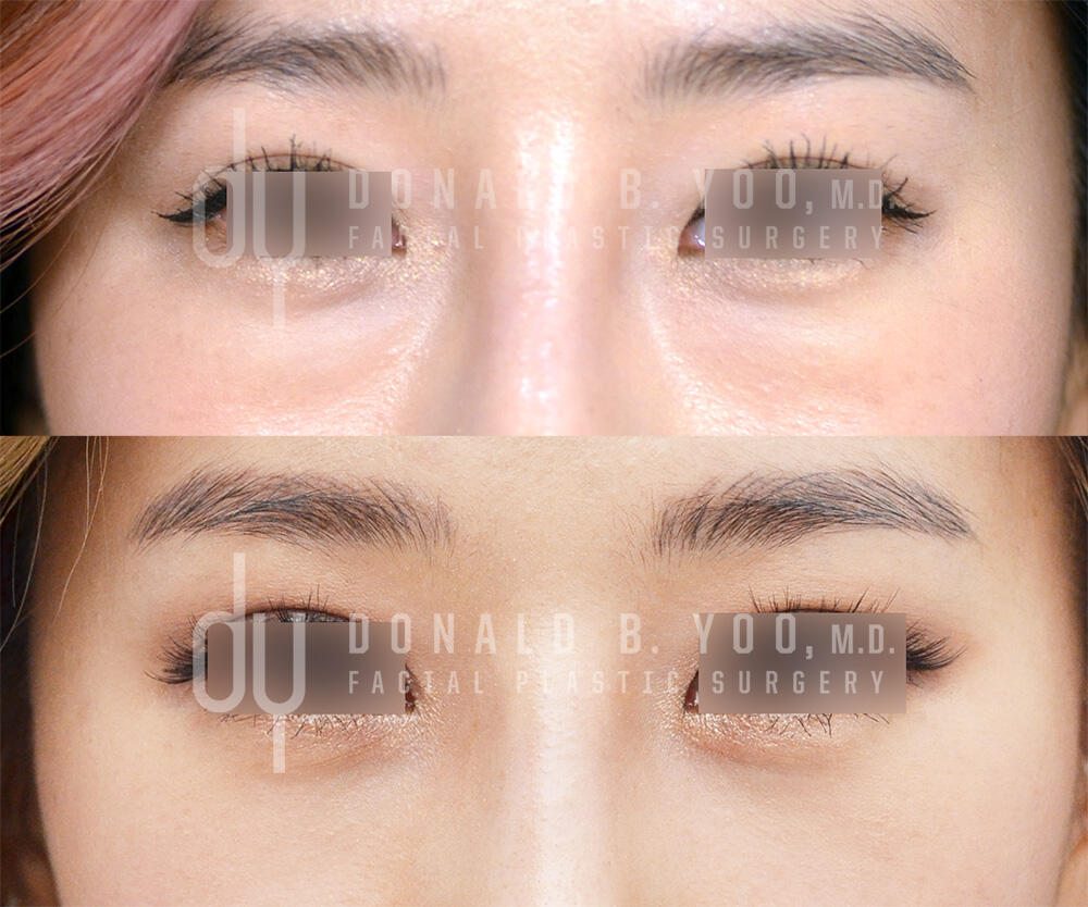 SURGICAL :: BLEPHAROPLASTY<br>Lower Blepharoplasty with Fat Repositioning