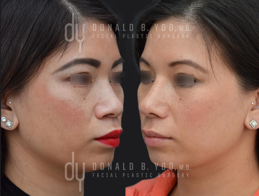 SURGICAL :: RHINOPLASTY<br>Asian Rhinoplasty with Alar Base Modification