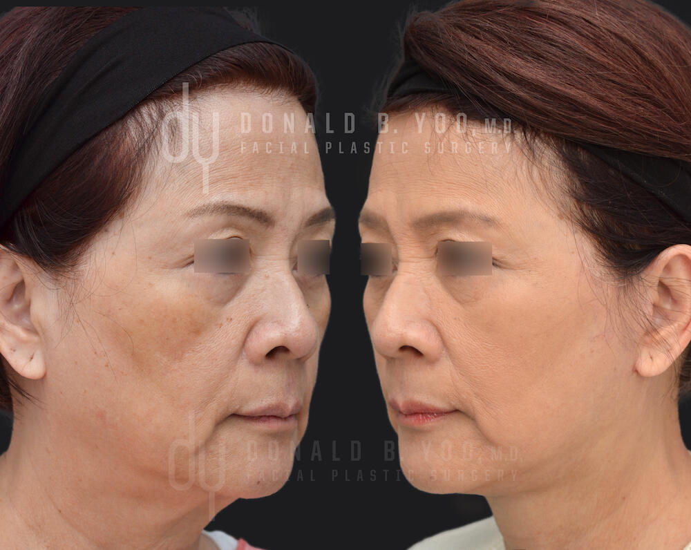 SURGICAL :: FACELIFT<br>Deep Plane Facelift