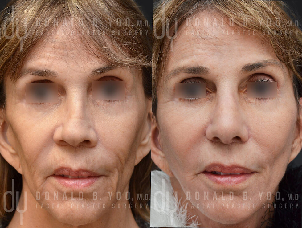 SURGICAL :: FACELIFT<br>Deep Plane Facelift and Rhinoplasty