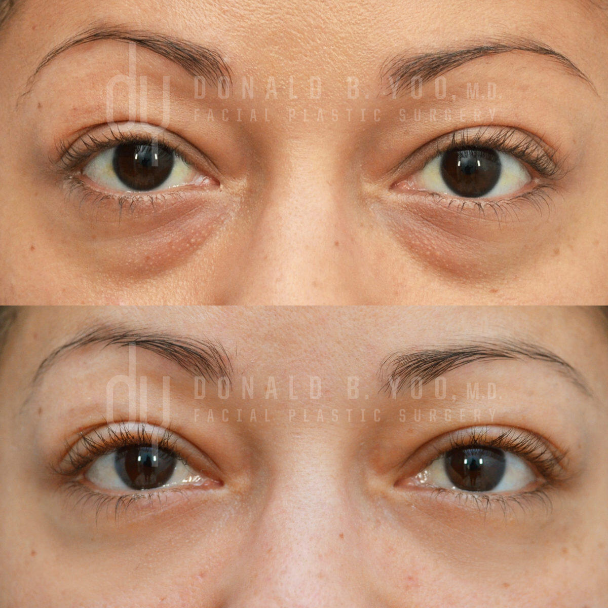 SURGICAL :: BLEPHAROPLASTY<br>Lower Blepharoplasty with Fat Repositioning