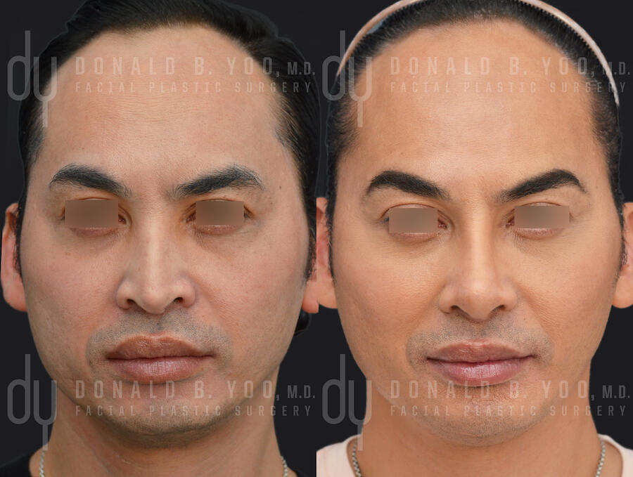 SURGICAL :: RHINOPLASTY<br>Male Rhinoplasty with Rib Cartilage and DCF