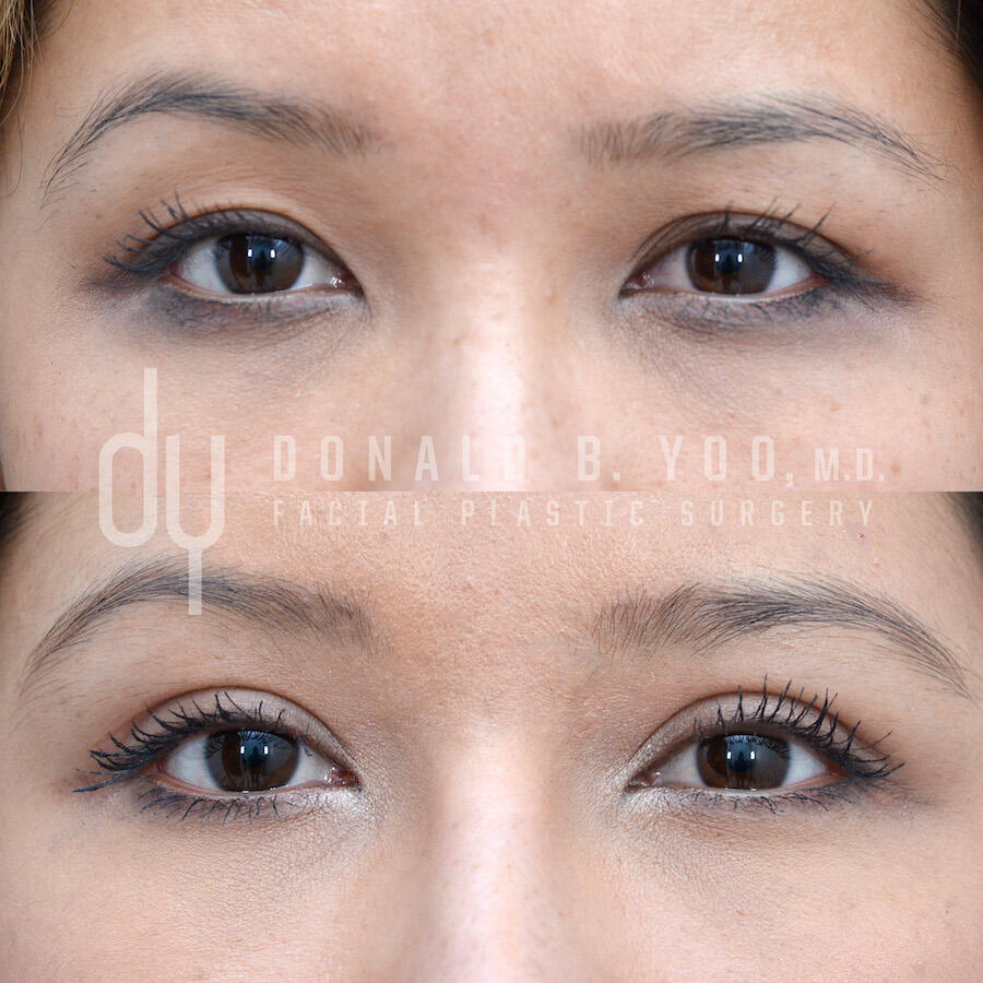 SURGICAL :: BLEPHAROPLASTY<br>Upper Blepharoplasty | Asian Double Eyelid