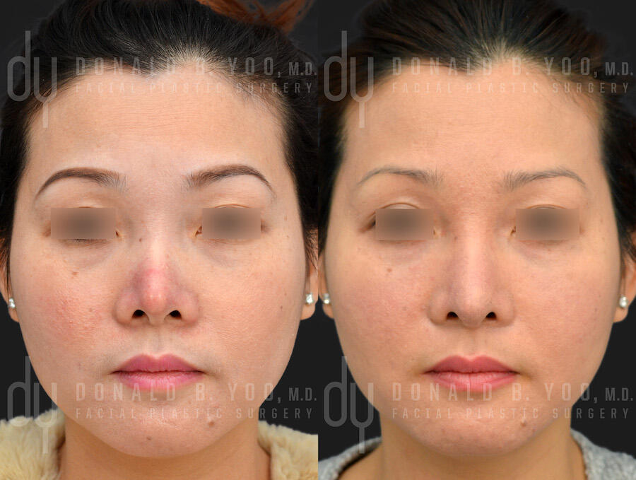 SURGICAL :: RHINOPLASTY<br>Revision Asian Rhinoplasty with Rib Cartilage and DCF