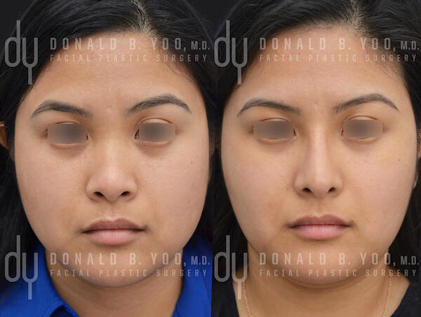 SURGICAL :: RHINOPLASTY<br>Asian Rhinoplasty with Rib Cartilage and DCF