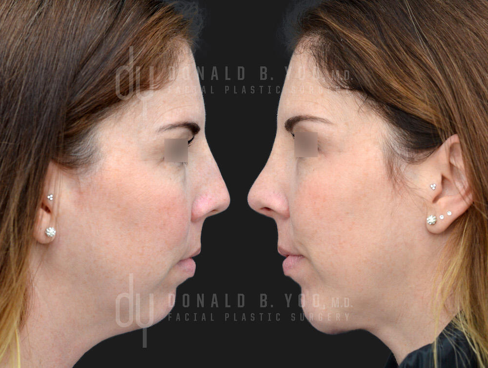 SURGICAL :: RHINOPLASTY<br>Rhinoplasty and Chin Augmentation