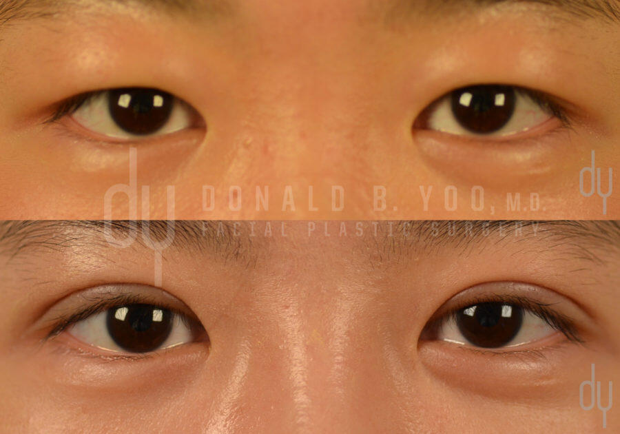 SURGICAL :: BLEPHAROPLASTY<br>Upper Blepharoplasty | Asian Double Eyelid