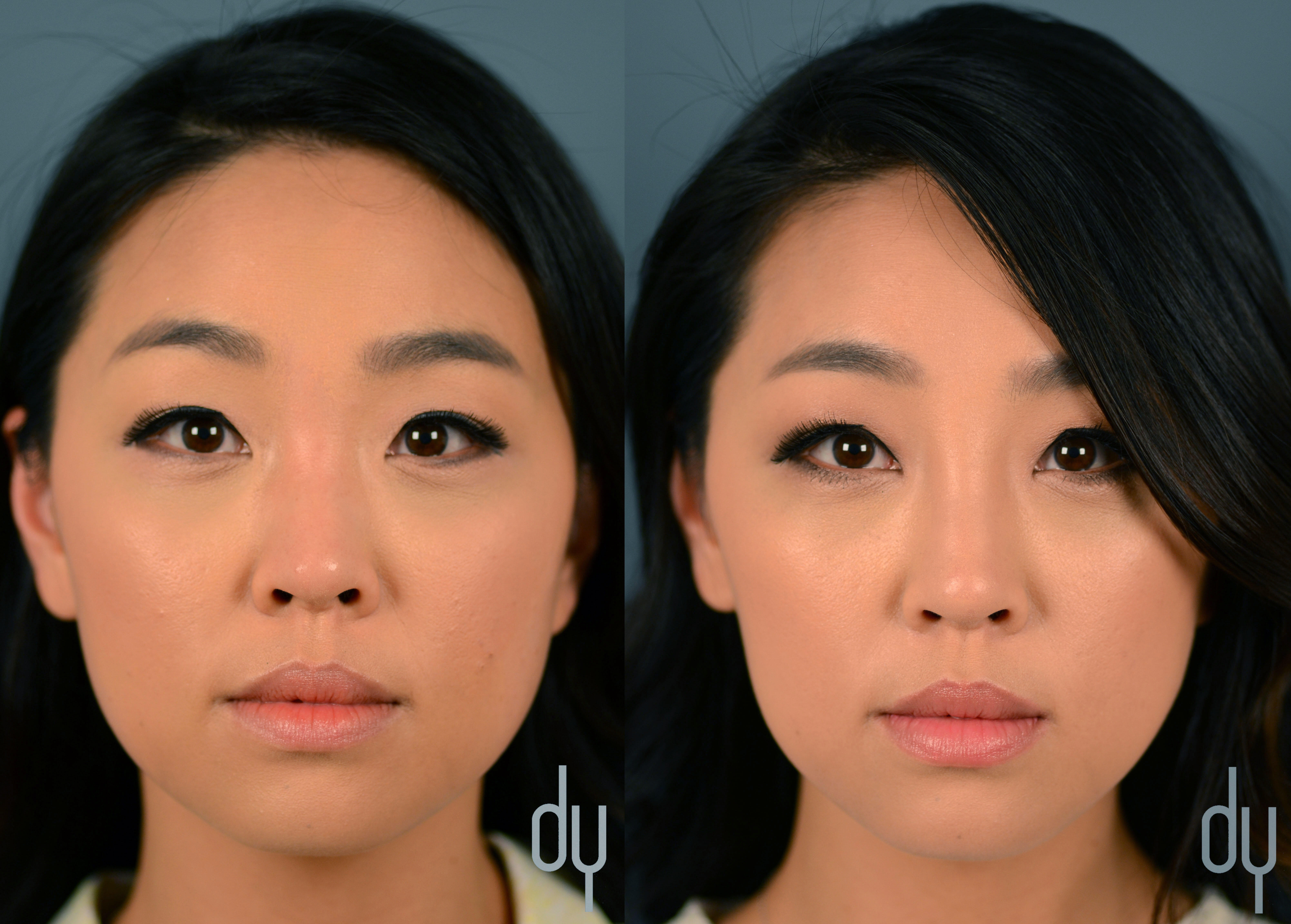 NONSURGICAL :: BOTOX<br>V-line Masseter Reduction