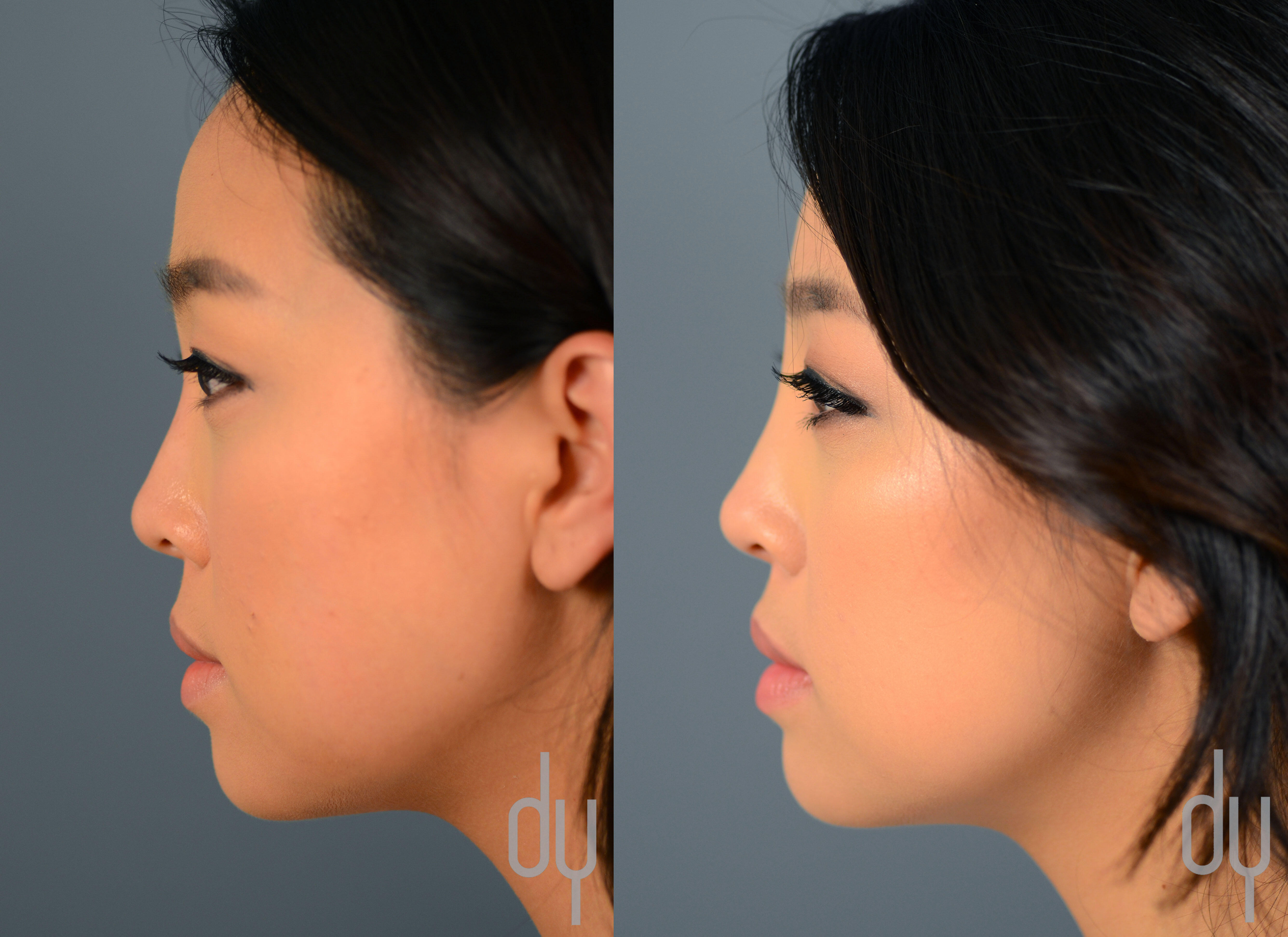 NONSURGICAL :: FILLERS<br>Nonsurgical Rhinoplasty