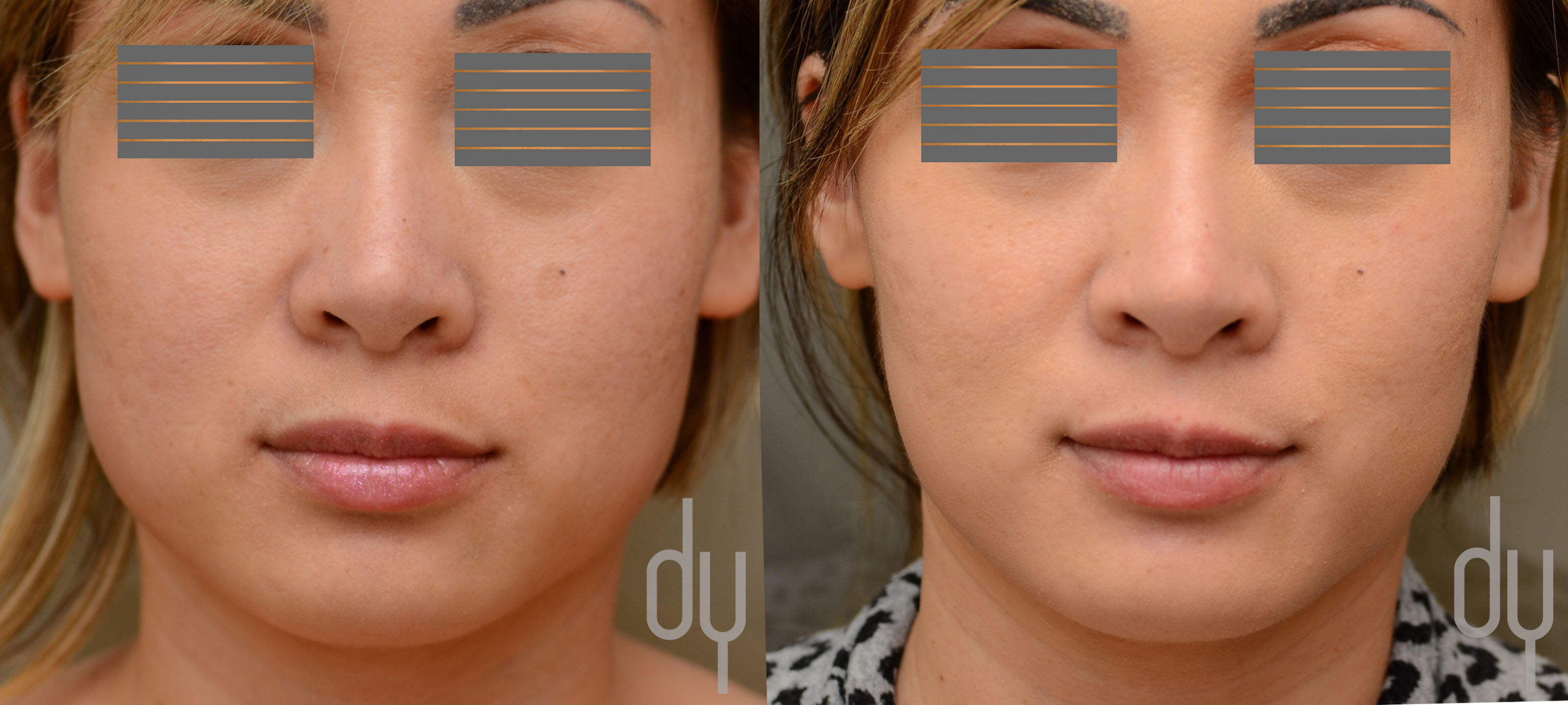 NONSURGICAL :: BOTOX<br>V-line Masseter Reduction