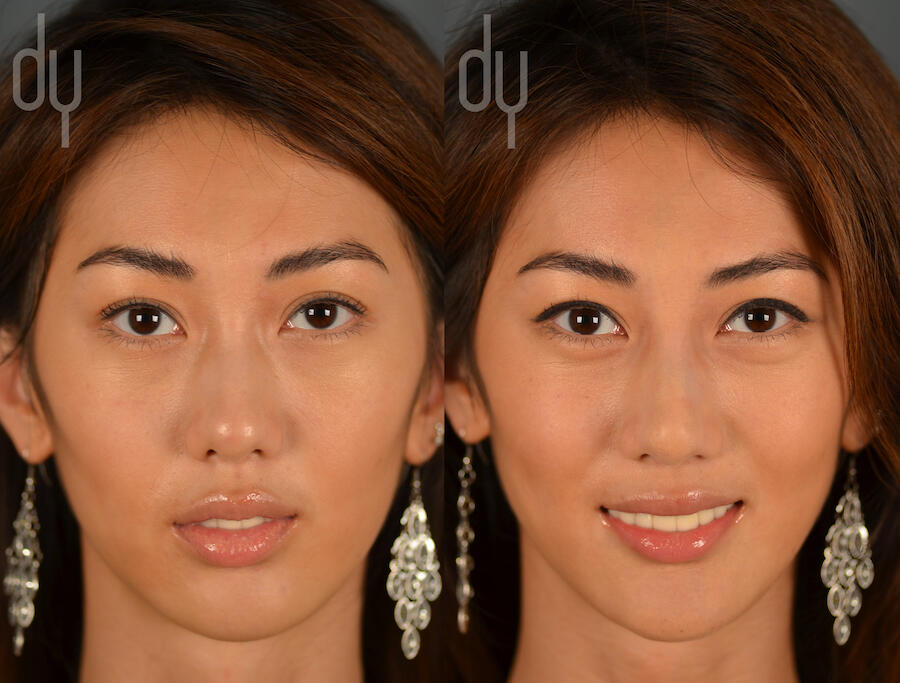 NONSURGICAL :: FILLERS<br>Nonsurgical Rhinoplasty