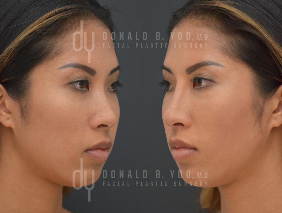 NONSURGICAL :: FILLERS<br>Nonsurgical Rhinoplasty