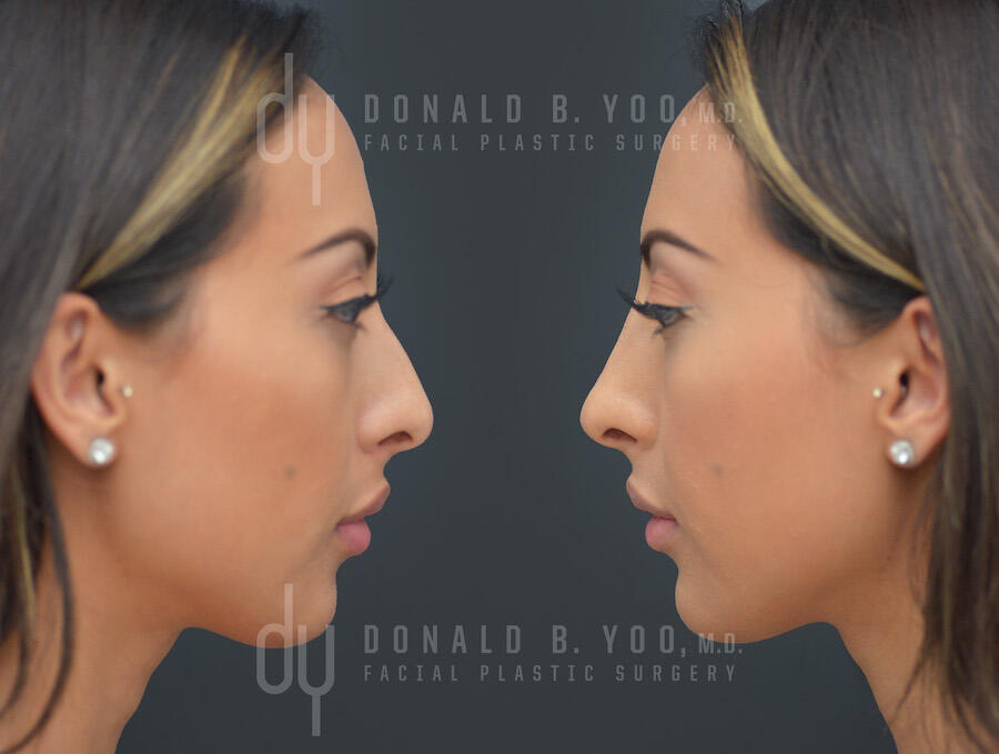 NONSURGICAL :: FILLERS<br>Nonsurgical Rhinoplasty