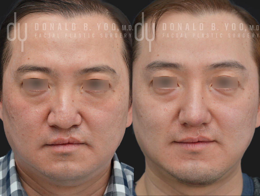 SURGICAL :: RHINOPLASTY<br>Male Rhinoplasty with Rib Cartilage and DCF