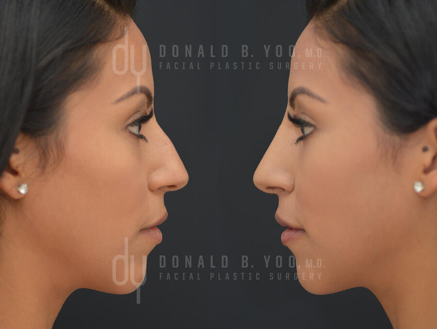 NONSURGICAL :: FILLERS<br>Nonsurgical Rhinoplasty